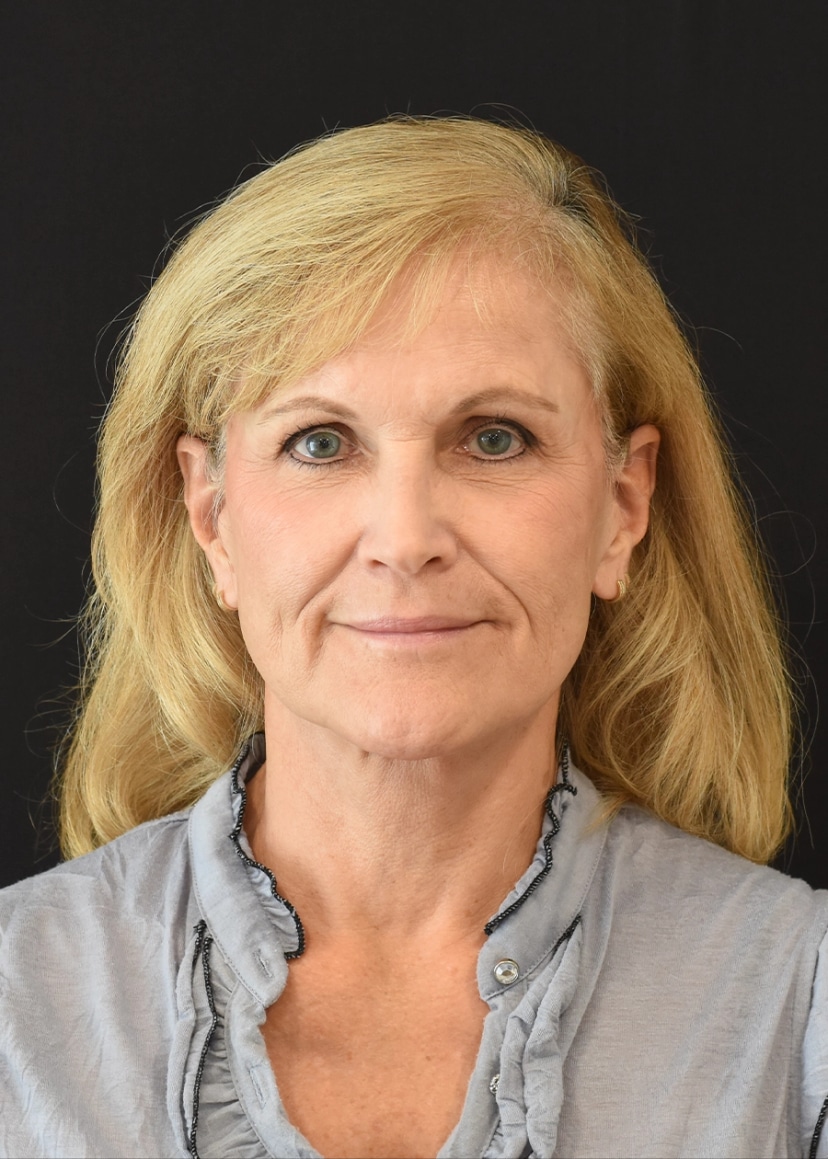 Extended Deep Plane Facelift Patient 12 Set 1 After